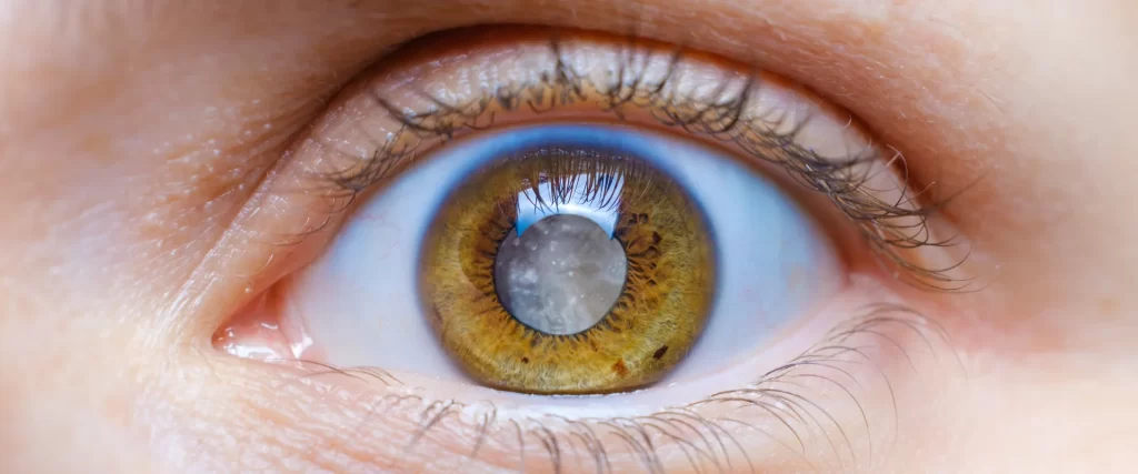 Cataract - Ways Diabetes Can Affect the Eyes