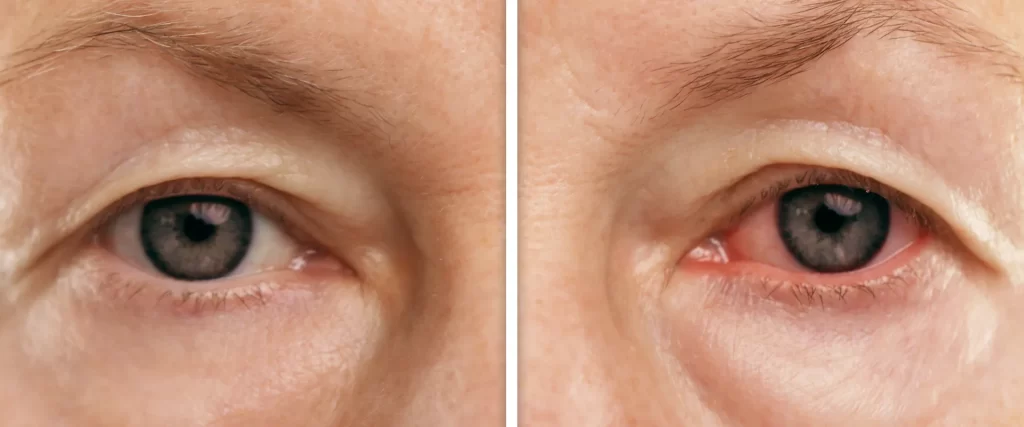 dry eye causes - normal vs. dry